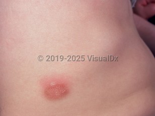 Clinical image of Mastocytoma - imageId=729955. Click to open in gallery.  caption: 'An edematous pink plaque with a peau d'orange appearance on the flank.'