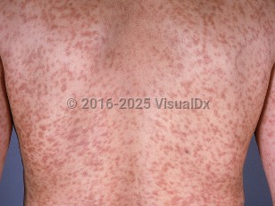 Clinical image of Mastocytosis in adults - imageId=739466. Click to open in gallery.  caption: 'A myriad of light brown and reddish macules and thin papules, some discrete and some confluent, on the back and arms.'