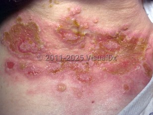 Clinical image of Paraneoplastic pemphigus - imageId=770851. Click to open in gallery.  caption: 'A close-up of large, crusted erosions with some purulence in areas, and surrounding erythema and flaccid vesicles on the lateral neck.'