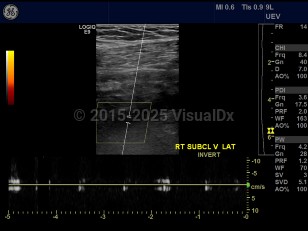Subclavian vein thrombosis