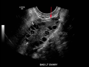Imaging Studies image of Polycystic ovarian syndrome - imageId=7884589. Click to open in gallery.  caption: '<span>Transvaginal ultrasound demonstrates enlarged ovary with multiple, small peripheral follicles. </span>'