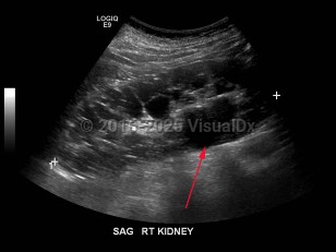 Imaging Studies image of Polycystic kidney disease - imageId=7911488. Click to open in gallery.  caption: '<span>Grayscale ultrasound image demonstrates enlarged right kidney with multiple cysts, some simple and others complex. The left kidney had a similar appearance.</span>'