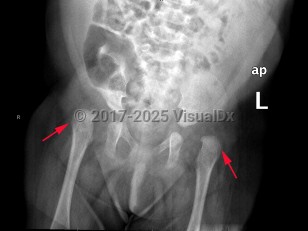 Imaging Studies image of Developmental dysplasia of the hip - imageId=8334771. Click to open in gallery.  caption: '<span>Bilateral dislocation of the  hips, with the hips oriented lateral and superior to the acetabula. The  acetabula are dysplastic bilaterally. These are imaging findings of  bilateral congenital hip dislocation.</span>'